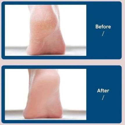 Electric foot file results before and after callus treatment
