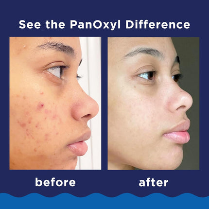 10% Benzoyl Peroxide Maximum Strength Acne Foaming Wash, 5.5 oz Tube