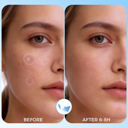 640-Count Hydrocolloid Pimple Patches for Face