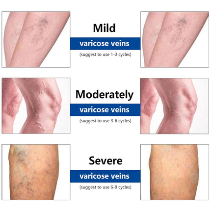 DriveForge ForjaRuta VeinTarget Microdarts Patch, Professional Varicose Veins Treatment for Legs — Auto & Moto