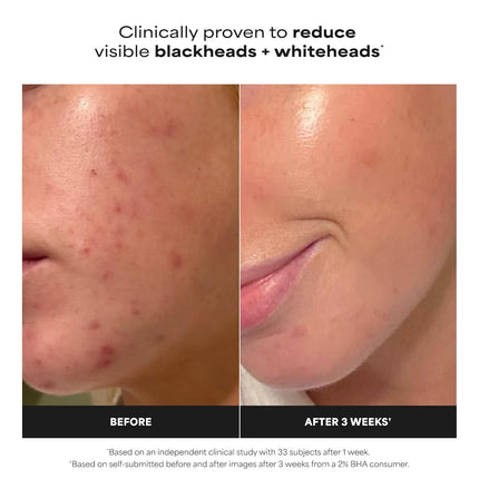 Skin Perfecting 2% BHA Liquid Salicylic Acid Facial Exfoliant, 4 oz