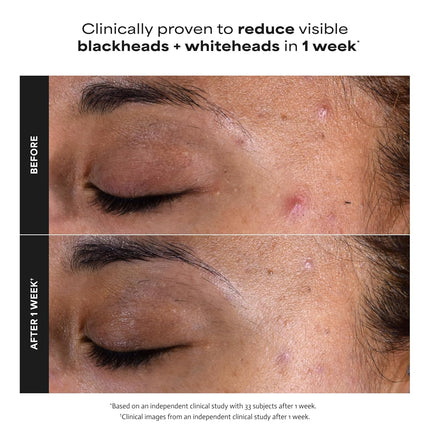 Skin Perfecting 2% BHA Liquid Salicylic Acid Facial Exfoliant, 4 oz