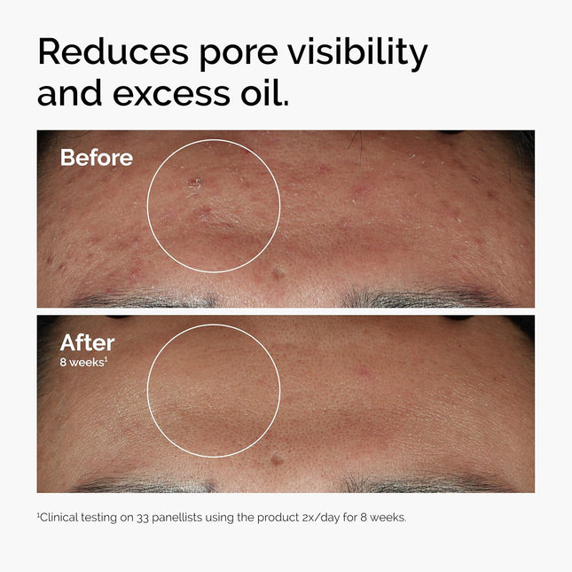 The Ordinary Niacinamide - Benefits