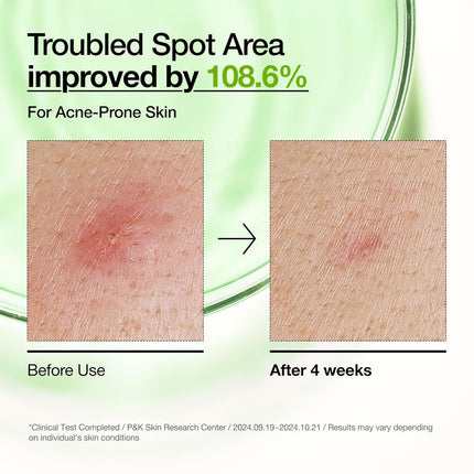 Azelaic Acid 10 Hyaluronic Redness Soothing Facial Serum